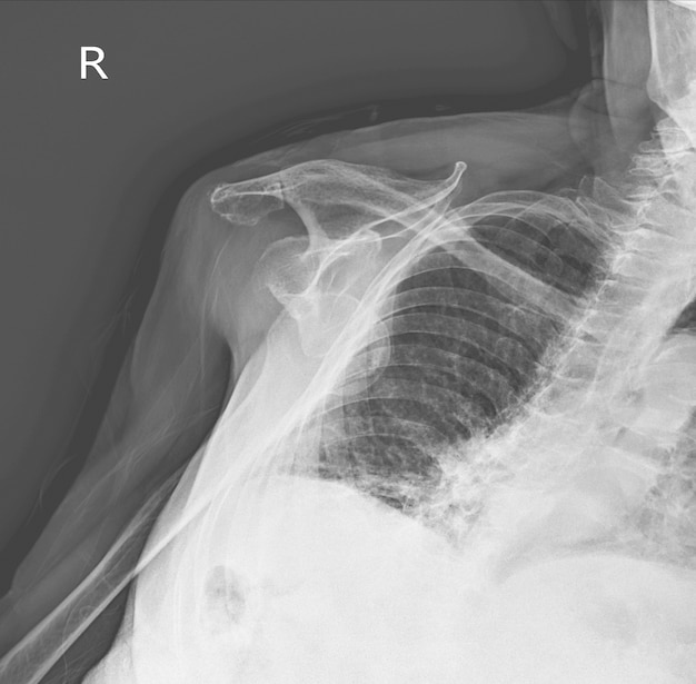 Rayos X Hombro de una mujer de 97 años. Articulación del hombro derecho por dislocación anterior.