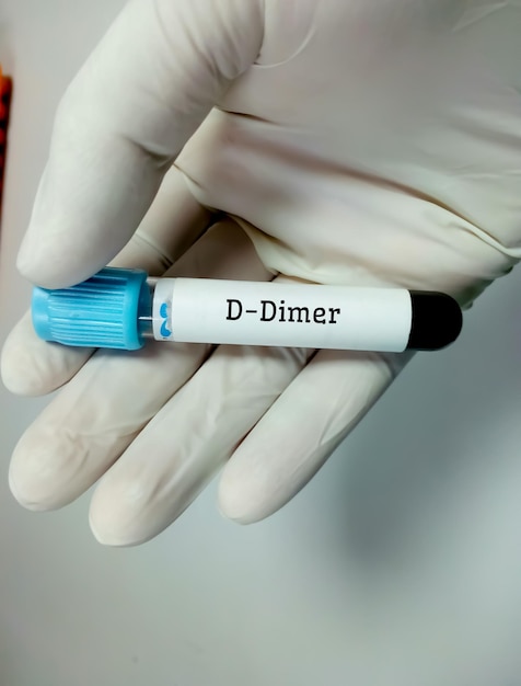 Reagenzglas mit Blutprobe für D-Dimer-Tests