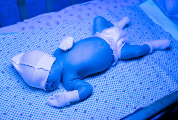 Recém-nascido em tratamento para icterícia sob luz ultravioleta, bebê apresenta alto nível de bilirrubina, deitado sob luz azul para reduzir o nível de icterícia. Procedimentos médicos seguros