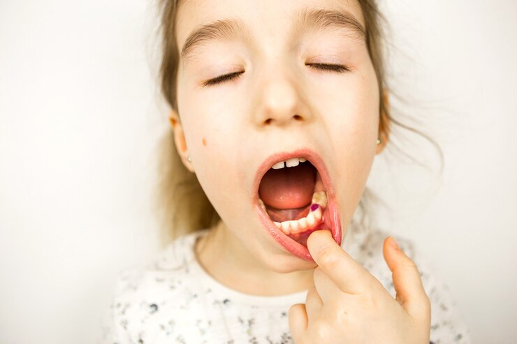 Foto recheio roxo colorido no dente de mascar leite da menina. odontologia pediátrica, tratamento e exame. uma criança com a boca aberta mostra um dente em close-up sobre um fundo branco.