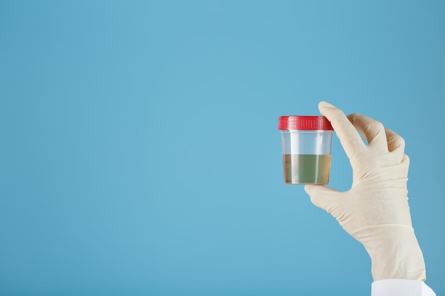 Un recipiente para biomaterial con un análisis de orina en la mano de un médico con un guante de goma blanco sobre un azul.
