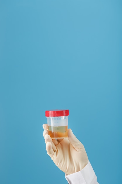 Un recipiente para biomaterial con un análisis de orina en la mano de un médico con un guante de goma blanco sobre un azul.