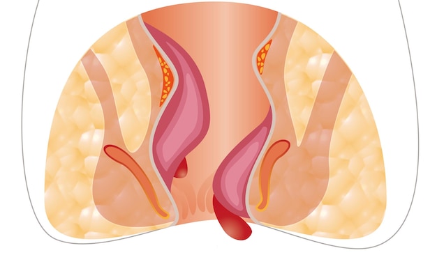 Recto inferior malsano de hemorroides con ilustración de estructuras vasculares inflamadas