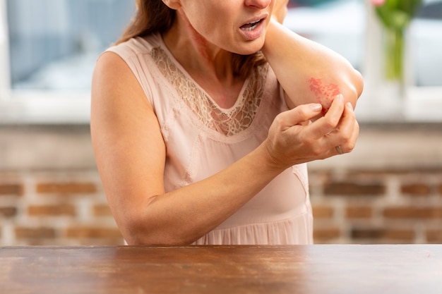 Reife Hausfrau mit starker Allergie, die neben dem Tisch steht und Ausschlag am Ellbogen hat