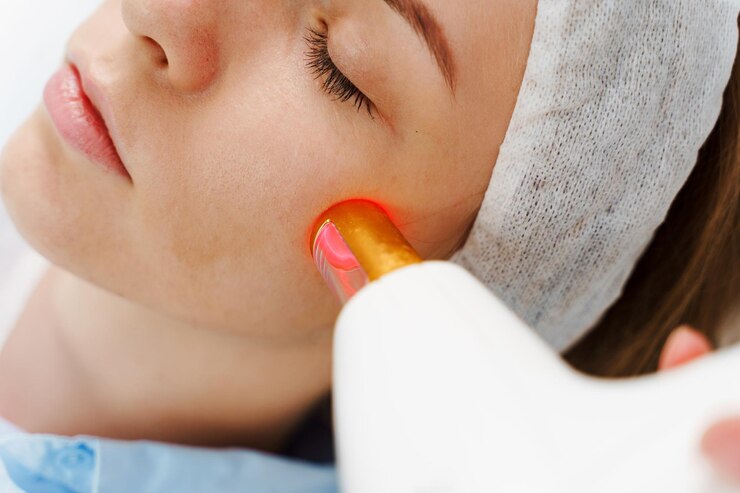Remoção da rosácea de pequenos vasos dilatados no rosto do paciente com laser de ultrassom IPL Tratamento a laser da rosácia por dermatologista Tratamento indolorável da rosacea em clínica de beleza