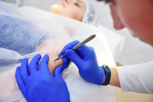 Remoção de tratamento cirúrgico médico de uma toupeira na mão de um paciente jovem. Uso de equipamentos modernos e seguros.