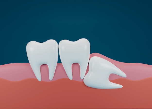 Render 3D de dientes con impactación mesial del juicio