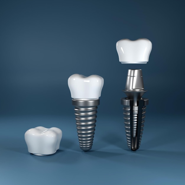 Representación 3d de cirugía de implantes dentales