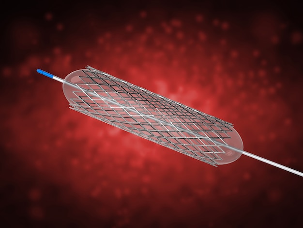 Representación 3D de stent o catéter para angioplastia con balón