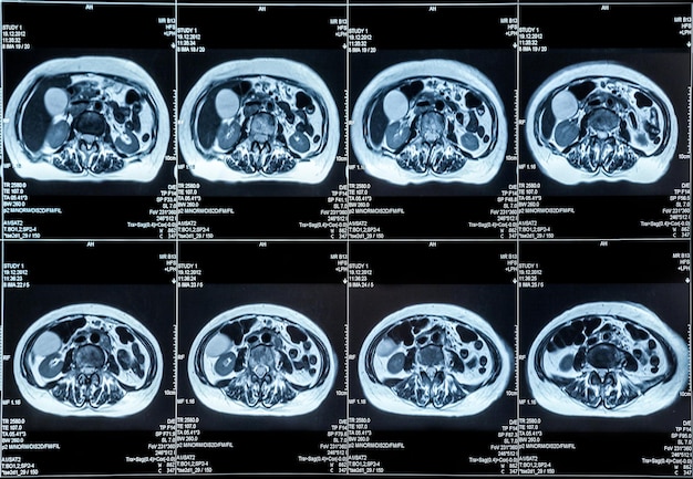 resonancia magnética de los órganos del abdomen humano