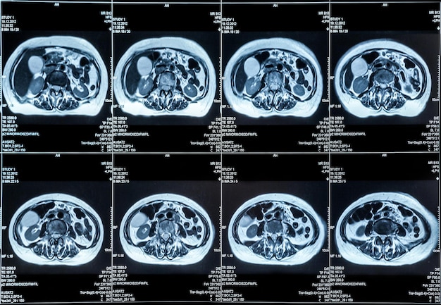 Foto resonancia magnética de los órganos del abdomen humano