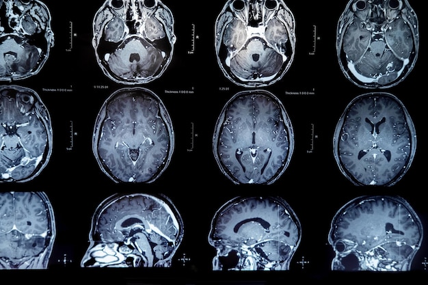 Ressonância magnética com tumor cerebral Ressonância magnética