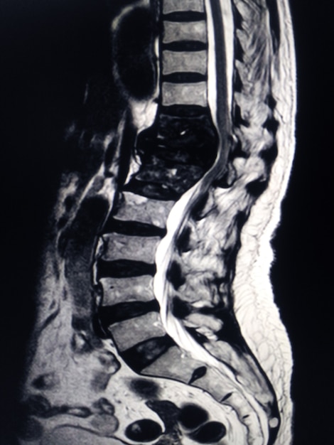 Ressonância magnética da coluna mri fratura de t12.