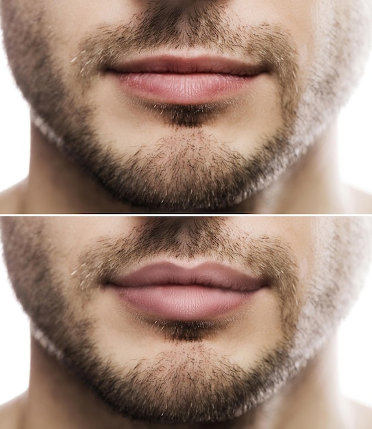 Resultado del aumento de labios. Labios masculinos antes y después de la inyección de relleno.