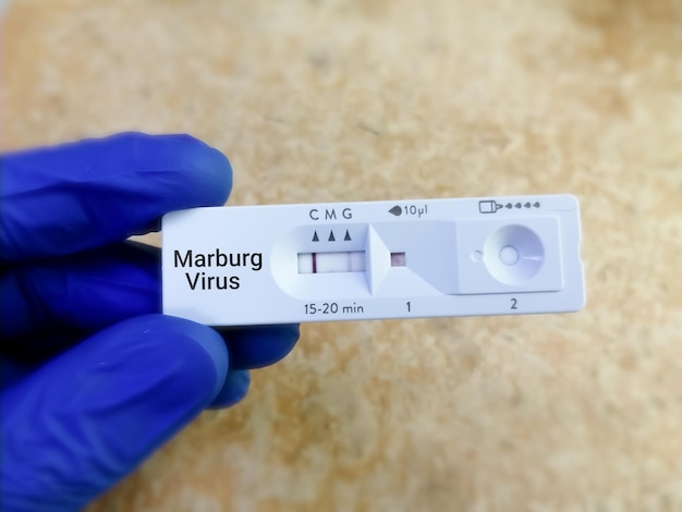 Resultado positivo de IgG del virus de Marburg mediante el uso de un casete de prueba rápida