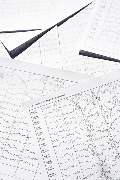 Foto resultados diagnósticos de electroencefalograma después de patrones de ondas cerebrales de epilepsia en eeg