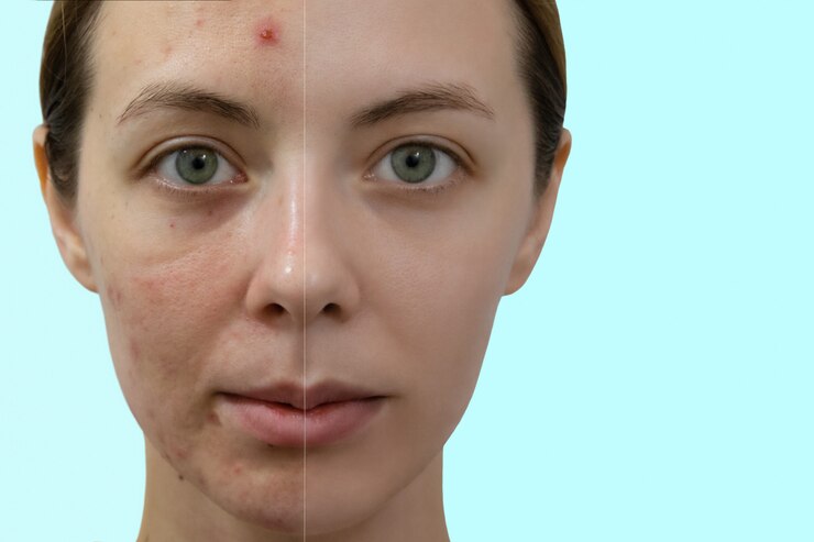 Foto retrato de comparação de uma mulher com pele problemática, sem e com maquiagem.