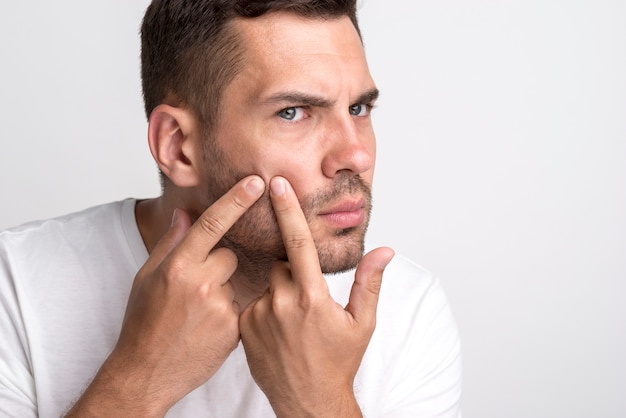 Retrato, de, homem jovem, espremer, espinhas, ligado, seu, bochecha