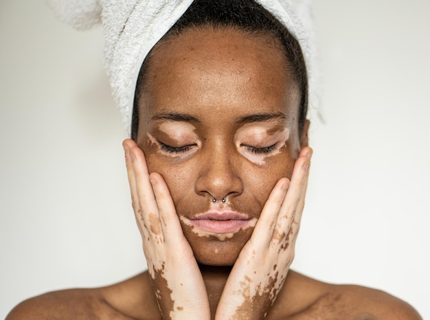 Retrato de jovem brasileira com vitiligo no rosto e nas mãos