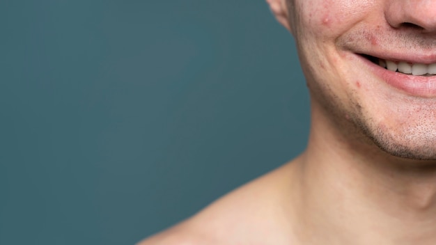 Foto retrato de jovem com acne e espaço de cópia