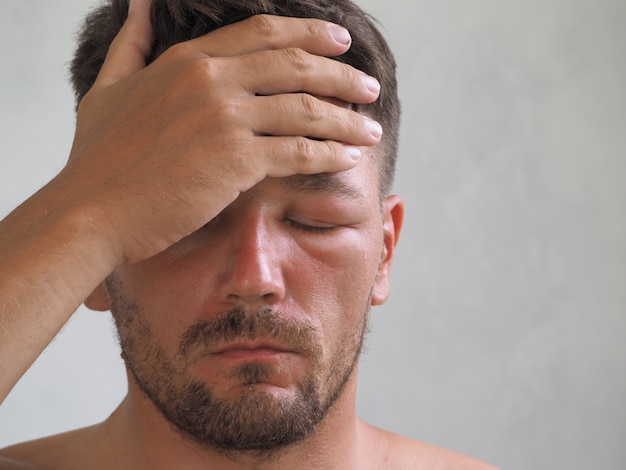 Retrato de um homem picado por uma vespa na testa