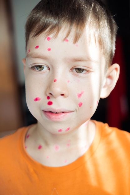 Retrato de um menino de 10 anos com varicela e uma erupção cutânea no rosto manchada com furacilina