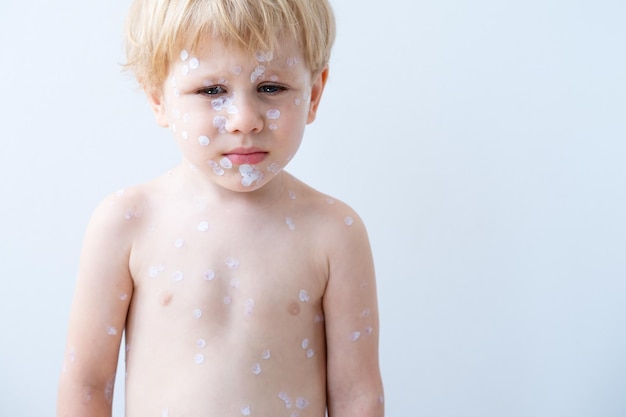 Retrato de um menino loiro com erupções vermelhas, vírus da varicela da varíola com creme médico