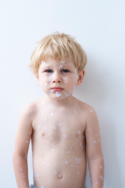 Retrato de um menino loiro com erupções vermelhas, vírus da varicela da varíola com creme médico