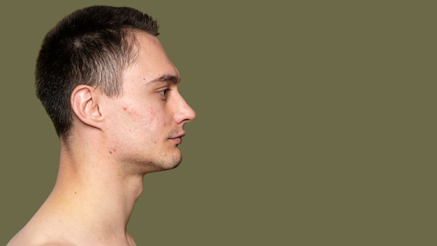 Retrato lateral de um jovem com acne