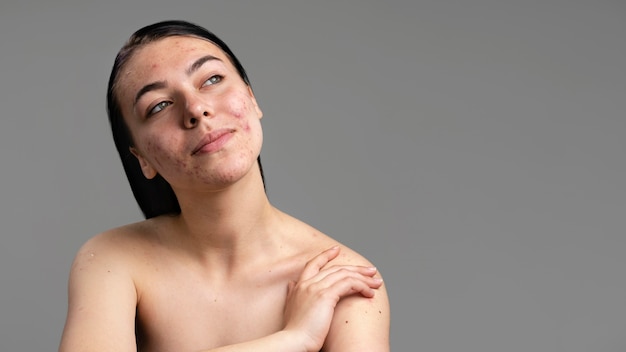 Foto retrato de mujer joven con acné