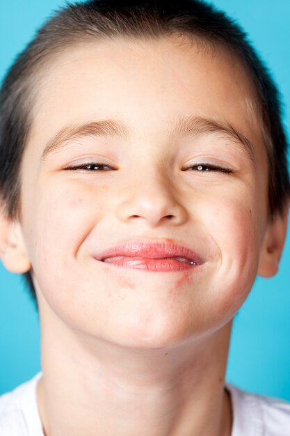 Retrato de un niño sonriente alegre con dermatitis perioral leve sobre un fondo azul.