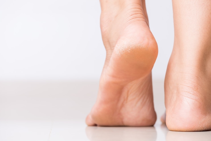 Foto risse an den fersen mit unreiner haut bedeckt. gesundheitswesen und medizinisches konzept.