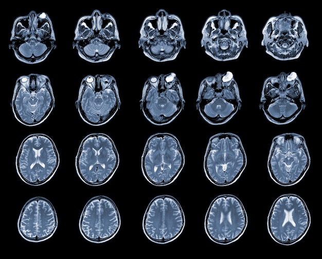 Foto rm do cérebro e órbita achado lesão cística bem delimitada com projeção papilar interna na face medial ocupando os compartimentos intra e extraconal da órbita esquerda conceito médico