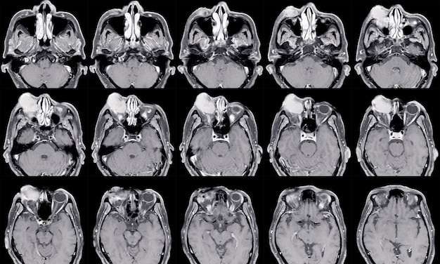 Rnm de cérebro e história de órbitas doença inflamatória orbital pseudotumor orbital imagem médica
