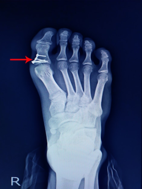 Röntgen der Fußfraktur
