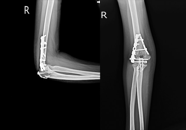 Röntgen-Ellenbogenpfosten OPIF-Platte