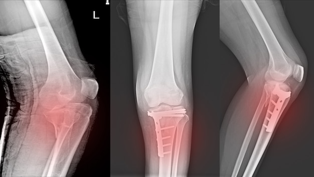 Röntgen-kniegelenkfraktur proximales tibia und postfix-fraktur proximales tibia.