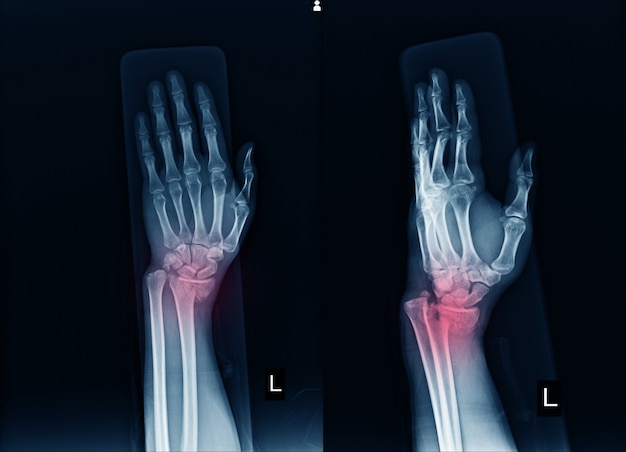 Röntgen Linkes Handgelenk Bruch mit linkem Radius des distalen Endes.