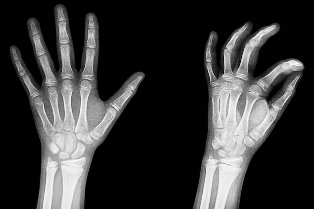 Röntgenbild der Hände Detail der Phalangen und Gelenke StrapezescaphoidPyramidalPisiformcapitate distal frontal proximal interflaginian lunate intercapitate
