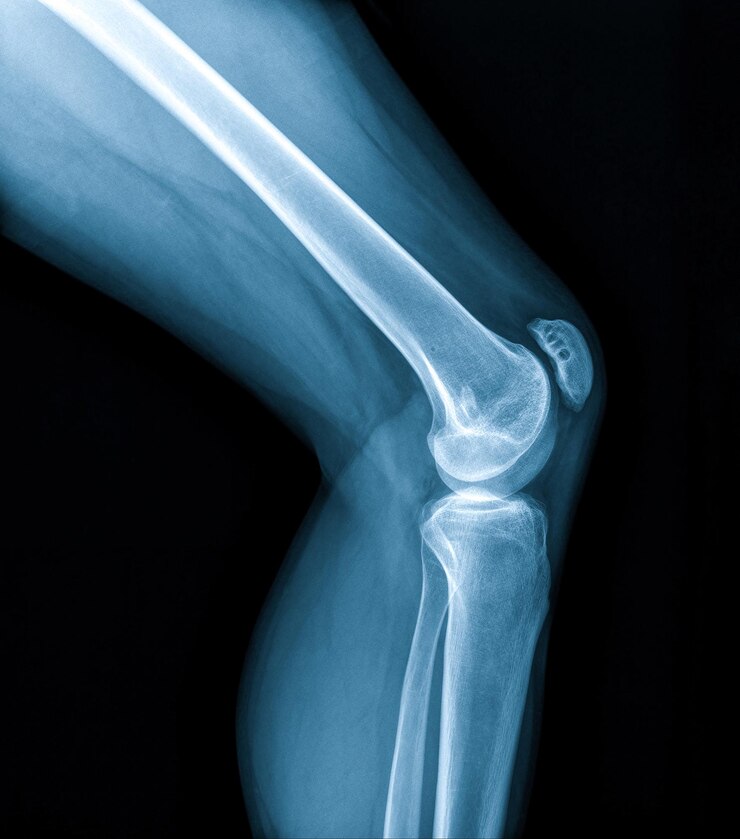 Röntgenbild des Kniegelenks AP und LATERAL Ansicht Fraktur und Verschiebung des Patella-Knochens oder der Kniekappe, rot hervorgehoben