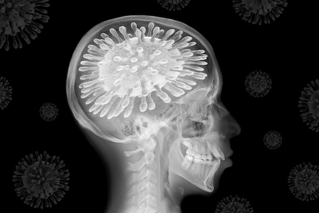 Röntgenbild eines Schädels mit COVID19 statt des Gehirns
