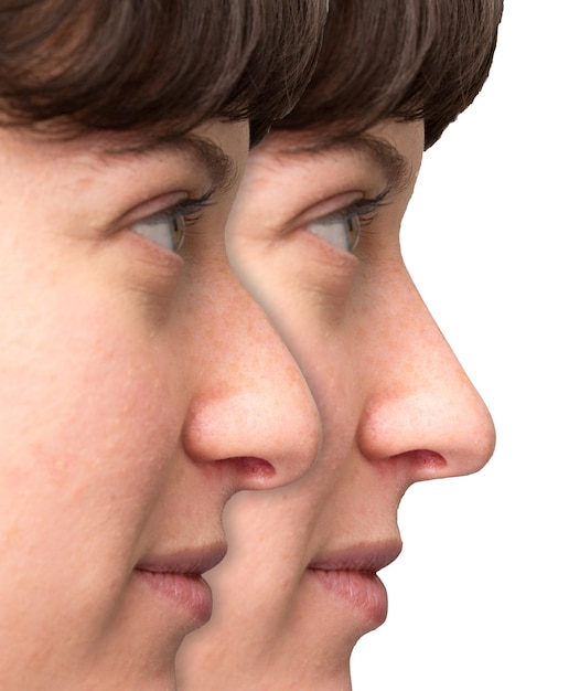 Rosto de mulher antes e depois da correção do nariz
