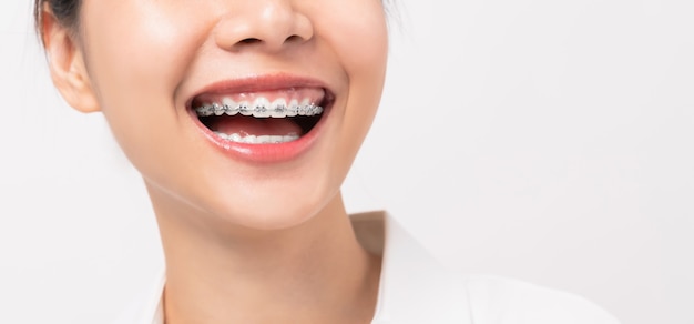 Foto rosto de uma jovem mulher asiática sorridente com aparelho nos dentes, tratamento ortodôntico.