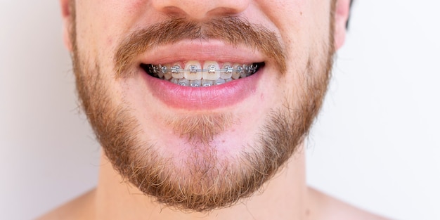 Rostro de hombre con bigote y barba con aparato de ortodoncia para corrección de dientes