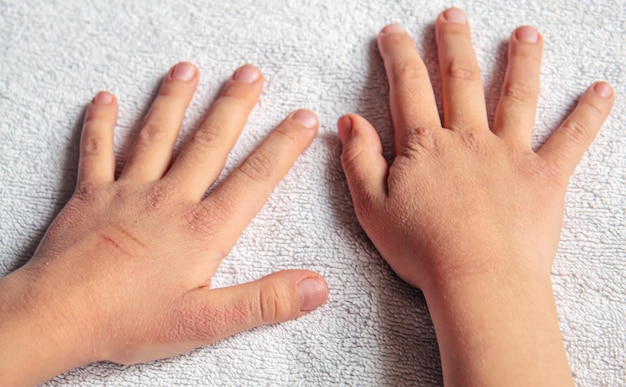 Rote Flecken auf der Haut der KinderhändeKinderallergieselektiver FokusNatur