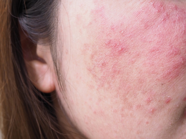 Foto roter ausschlag im gesicht der jungen frau, juckende und allergische hautprobleme, dermatitis