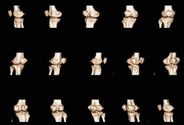 Sammlung von Röntgenaufnahmen von menschlichen Kniegelenken, die eine Fraktur der proximalen Metaphyse der Tibia finden