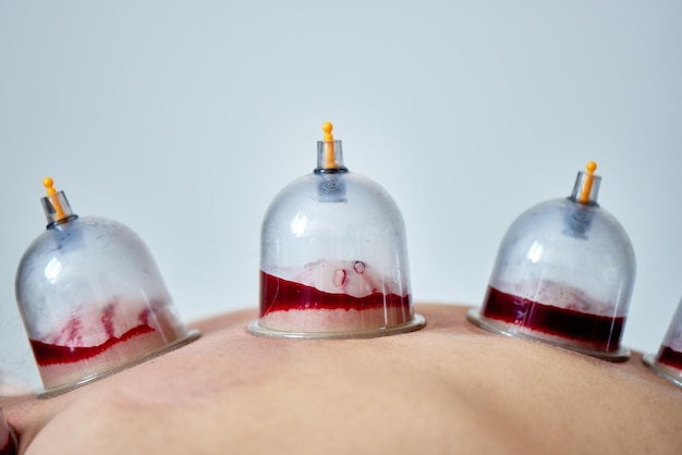 Sangria curativa, hijama ou flebotomia. Mestre Hajam conduz terapia de ventosa em uma jovem. medicina islâmica