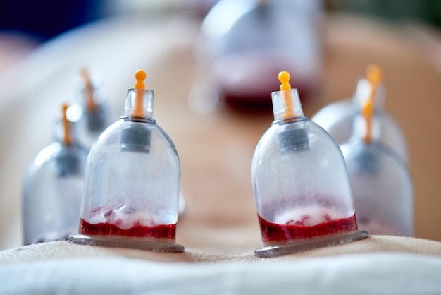 Sangria curativa, hijama ou flebotomia. Mestre Hajam conduz terapia de ventosa em uma jovem. medicina islâmica