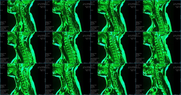 Satz von 6 sagittalen grün gefärbten MRT-Scans des Halsbereichs eines kaukasischen 34-jährigen Mannes mit bilateraler paramedialer Extrusion des C6C7-Segments